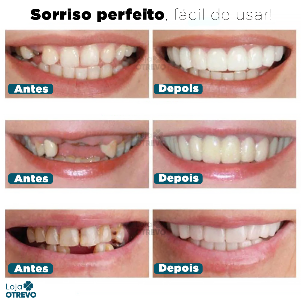 Nature Smile® - Facetas Dentárias Removíveis